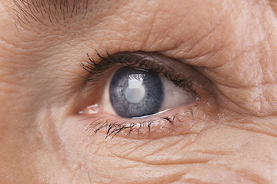 Oronoque Eye Care | Dry Eye Treatment, Optical Department and Macular Degeneration Screening